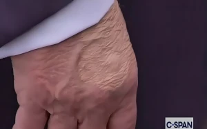 أول تعليق من البيت الأبيض على ظهور كدمة غريبة على يد ترامب-فيديو