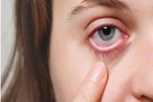 لا تتجاهلها.. 7 أعراض تدل على الإصابة بسرطان العين