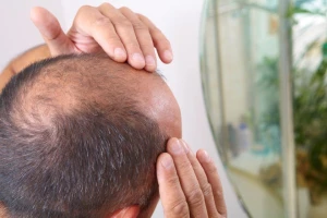 «بدون أدوية أو زراعة».. اكتشاف علاج جديد لتساقط الشعر والصلع الوراثي
