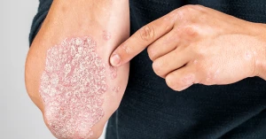 إدارة الغذاء والدواء الأميركية توافق  على أول دواء  لمعالجة الصدفية