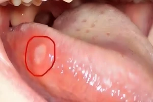 خبراء يكشفون عن أعراض  تظهر على اللسان تشير إلى الإصابة بالسرطان