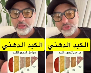 بالفيديو.. طبيب يكشف عن 3 مشروبات لعلاج "الكبد الدهني" ويوضح وقت التعافي وظهور النتائج !