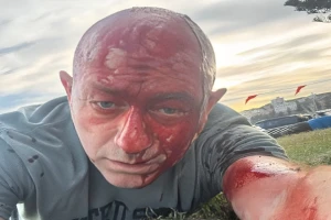 رئيس مجلس اليهود الأستراليين يوثق لحظة إصابته في الرأس في الهجوم المسلح في سيدني