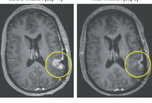 اختفاء الورم خلال 5 أيام فقط…الكشف عن علاج جديد يقضي على أحد أكثر أنواع السرطانات فتكًا ومقاومة للعلاج