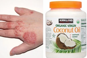 زيت جوز الهند.. سر جديد لعلاج الإكزيما بنسبة 70% خلال 8 أسابيع فقط