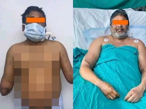 ‏بعد جراحة استمرت 12 ساعة.. أطباء ينجحون في زراعة يدين لرسام هندي