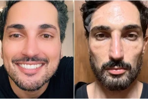 «خلال 60 يومًا فقط».. صانع محتوى أمريكي يتحدث عن نتائج غير متوقعة لاستخدام «مونجارو»
