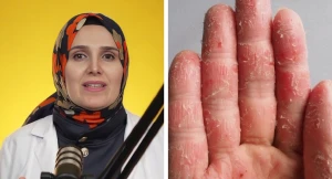 طبيبة تكشف عن أطعمة شائعة  تسبب تفاقم الإكزيما