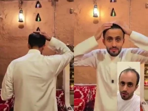 بالفيديو: مشهور سناب عبدالرحمن الراشد يكشف عن نتيجة زراعة الشعر بعد عام من العملية.. ويوضح الخطة العلاجية التي اتبعها