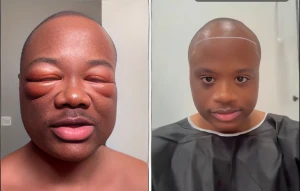 بالفيديو.. صانع محتوى يكشف كيف تغير وجهه بعد عملية زراعة شعر في تركيا ويثير الجدل