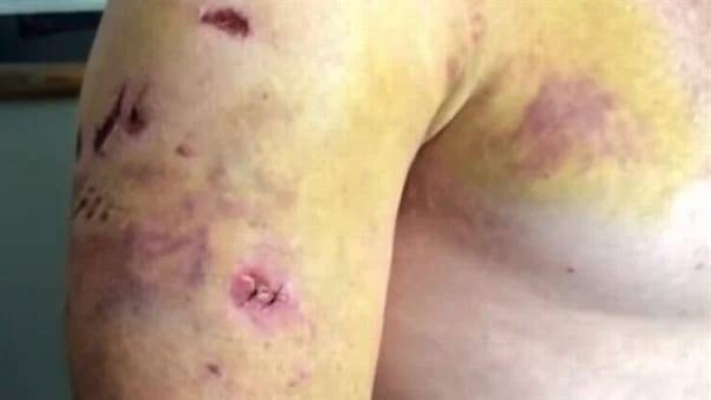 شاهد .. صور صادمة لصياد يتعرض لـ 25 عضة من دب شرس