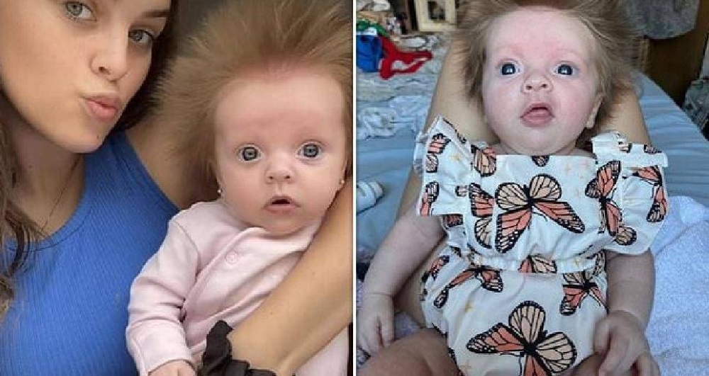 "لا يمكن تسريحه".. شاهد : الطفلة "القنفذ" ينمو شعرها بطريقة غريبة