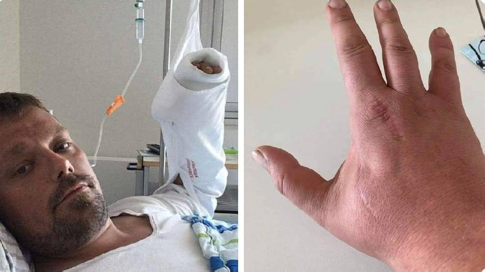 شاهد: ماذا حدث لرجل بعد مرور 4 سنوات على تعرضه لعضة قطة