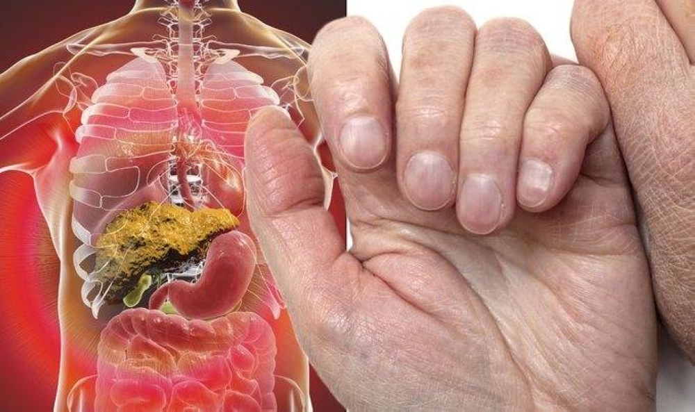 علامات تظهر على الأظافر تشير إلى الإصابة بالتليف الكبدي
