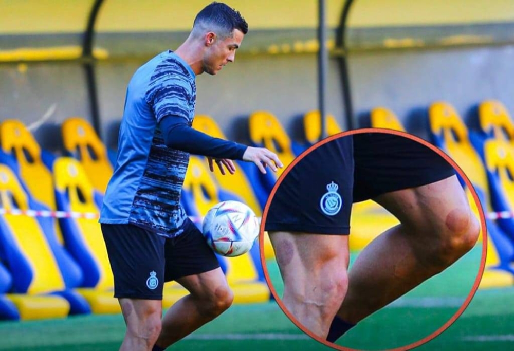 شاهد: بقع دائرية على فخذ رونالدو تثير الجدل بشأن علاجه بالحجامة