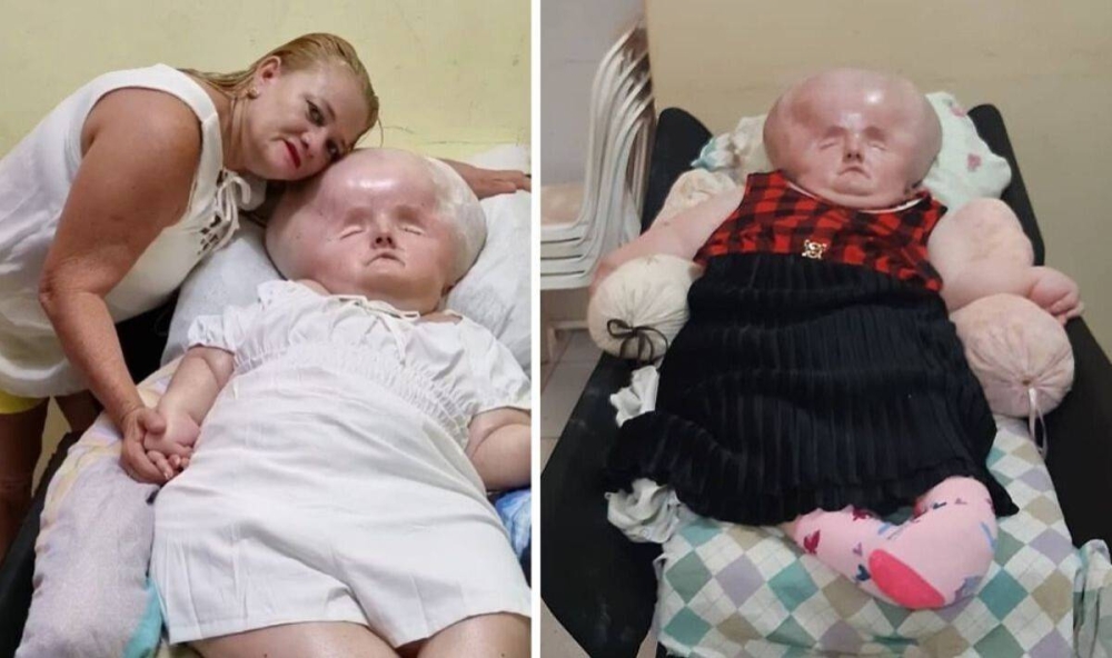 شاهد .. امرأة تعاني من مرض نادر يتسبب في تضخم حجم رأسها 3 أضعاف