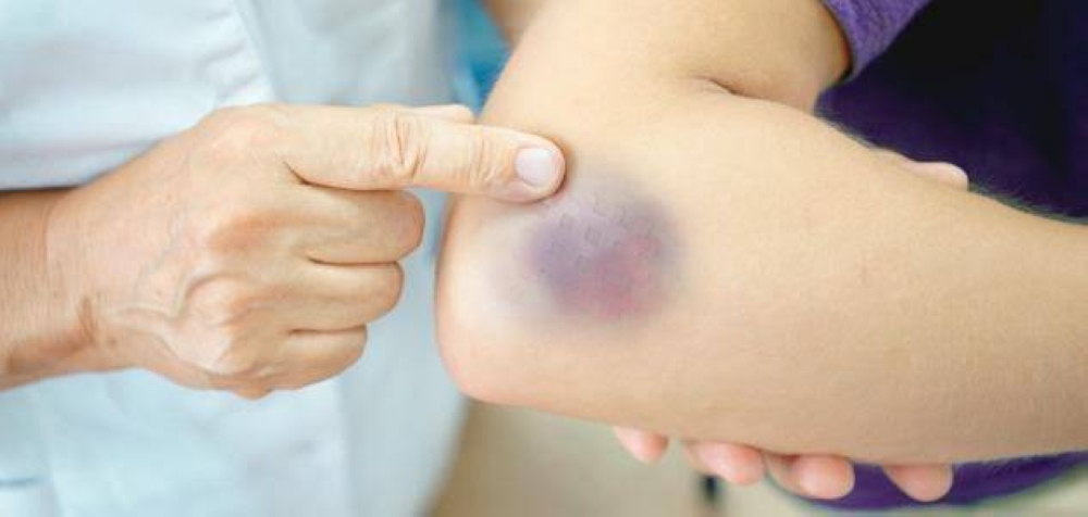 أخصائية قلب تكشف أسباب غير متوقعة لظهور الكدمات المفاجئة في الجسم