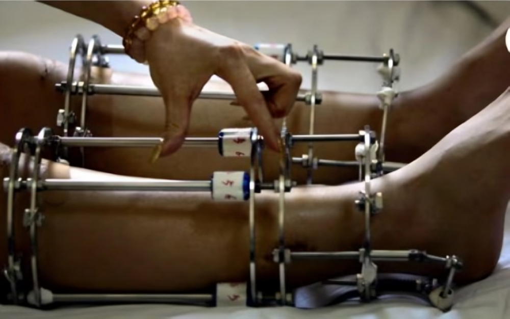 تفاصيل وفاة مواطن سعودي بعد عملية تطويل القامة في تركيا