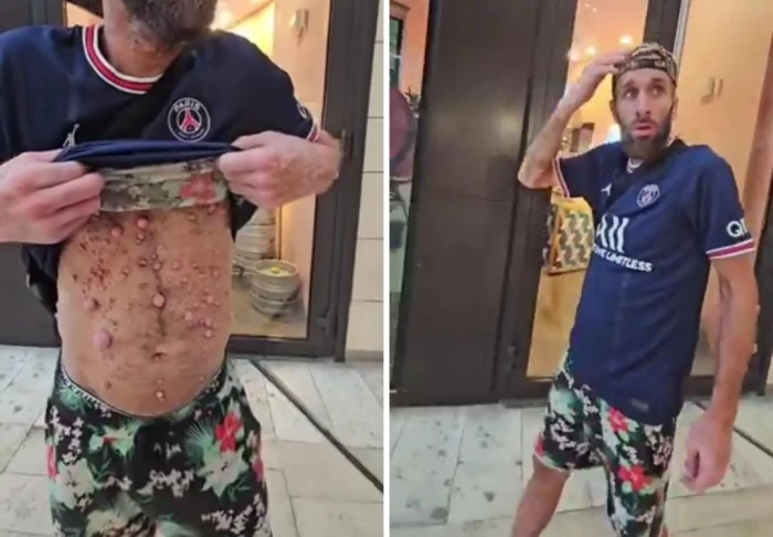 «منظر صادم».. شاهد.. مصاب بجدري القرود يتجول في شوارع فرنسا