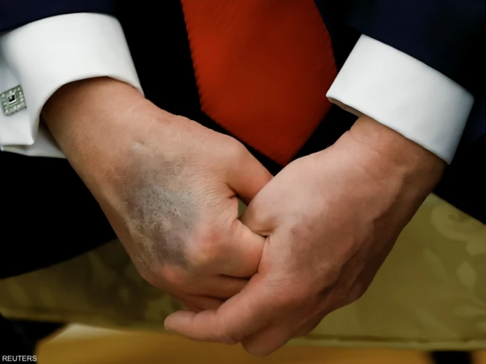 طبيب ترامب يكشف أسباب ظهور كدمة «زرقاء داكنة» جديدة على يده.. ويوضح حالته الصحية