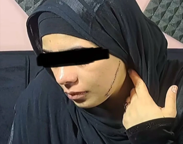 «41 غرزة في الوجه».. سيدة مصرية تشوه وجه عروس طليقها قبل أيام من زفافها في القاهرة