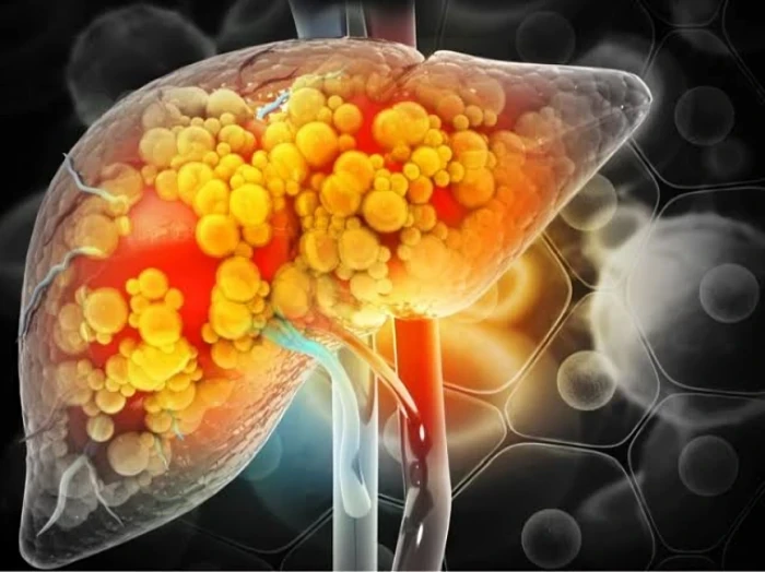 «التهديد الصامت».. الكشف عن 5 علامات تشير إلى تعافي الكبد الدهني