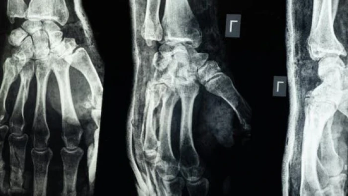 باحثون صينيون يعلنون عن ابتكار غراء عظمي يعالج الكسور في 3 دقائق