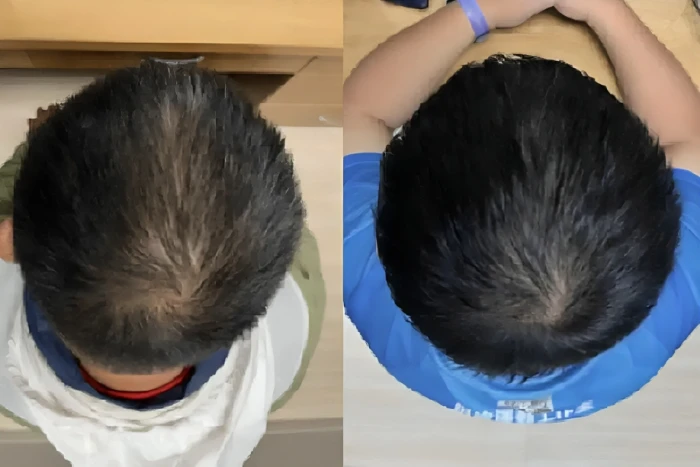 مصل جديد لعلاج تساقط الشعر يحقق نتائج فعالة خلال شهرين