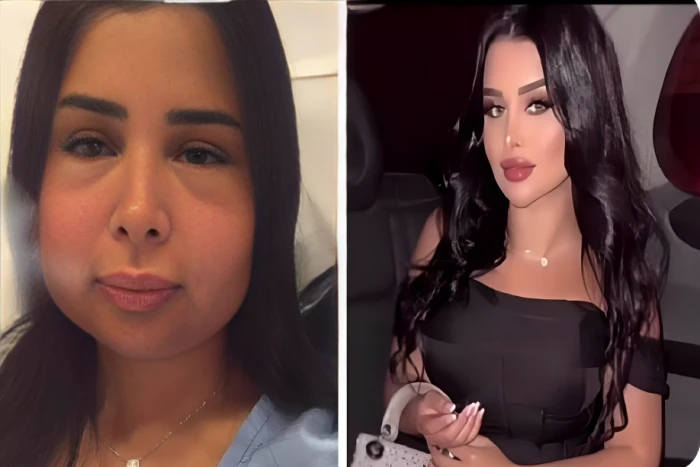 بالصور.. تشوّه وجه المودل دانا الشهري بعد عملية تجميل فاشلة في الرياض