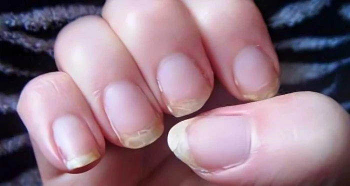 بعضها يشير للسرطان.. 6 علامات على أظافر اليد تكشف عن أمراض خطيرة!