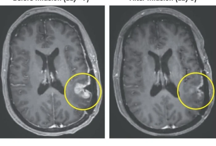 اختفاء الورم خلال 5 أيام فقط…الكشف عن علاج جديد يقضي على أحد أكثر أنواع السرطانات فتكًا ومقاومة للعلاج