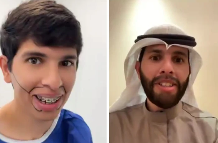 بالفيديو: شاب ثلاثيني يوثق مظهره قبل وبعد زراعة اللحية