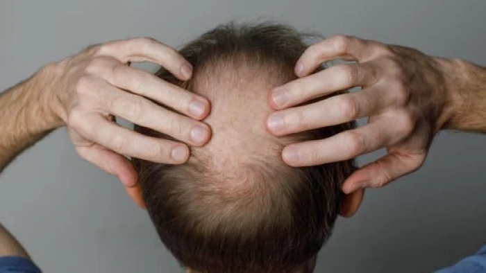 عشبة صينية قديمة تثبت فاعلية كبيرة في مواجهة الصلع.. وهذا ما يحدث لفروة الرأس عند استخدامها!