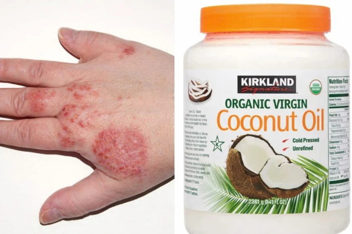 زيت جوز الهند.. سر جديد لعلاج الإكزيما بنسبة 70% خلال 8 أسابيع فقط