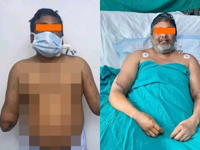 ‏بعد جراحة استمرت 12 ساعة.. أطباء ينجحون في زراعة يدين لرسام هندي