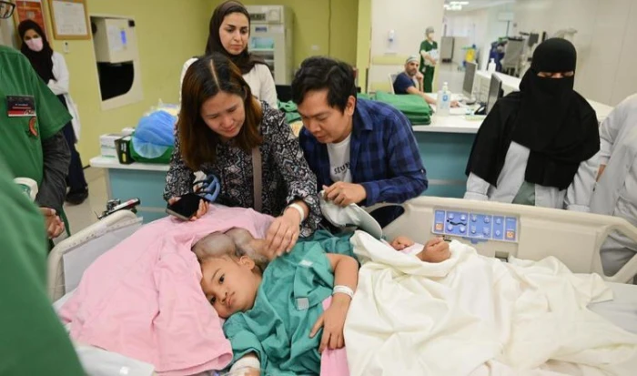 "الربيعة" يكشف تفاصيل عملية فصل التوأم الملتصق الفلبيني "كليا وموريس آن".. ويحدد نسبة الخطر!