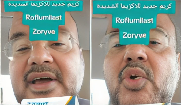بالفيديو: طبيب جلدية يكشف عن كريم موضعي جديد للإكزيما والصدفية بديلًا للكورتيزون