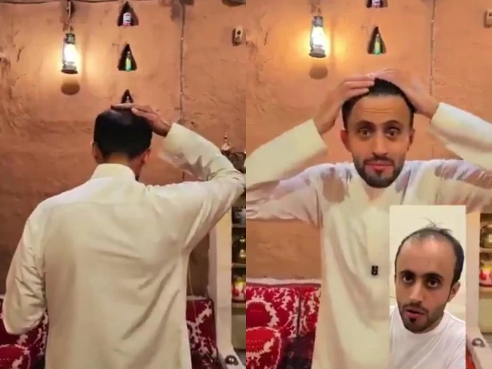 بالفيديو: مشهور سناب عبدالرحمن الراشد يكشف عن نتيجة زراعة الشعر بعد عام من العملية.. ويوضح الخطة العلاجية التي اتبعها