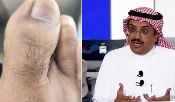 هل اختفاء شعر أصابع القدم دليلًا قاطعًا على صحة القلب؟.. خالد النمر يجيب