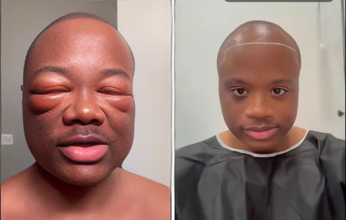 بالفيديو.. صانع محتوى يكشف كيف تغير وجهه بعد عملية زراعة شعر في تركيا ويثير الجدل