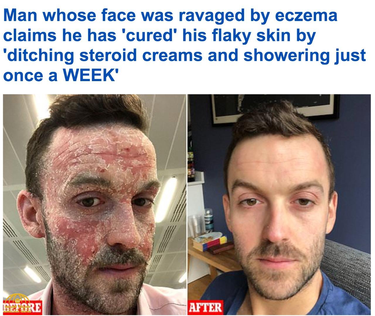 بالصور .. شاهد كيف تخلص بريطاني من أعراض الإكزيما بدون استخدام أدوية أو كريمات للبشرة