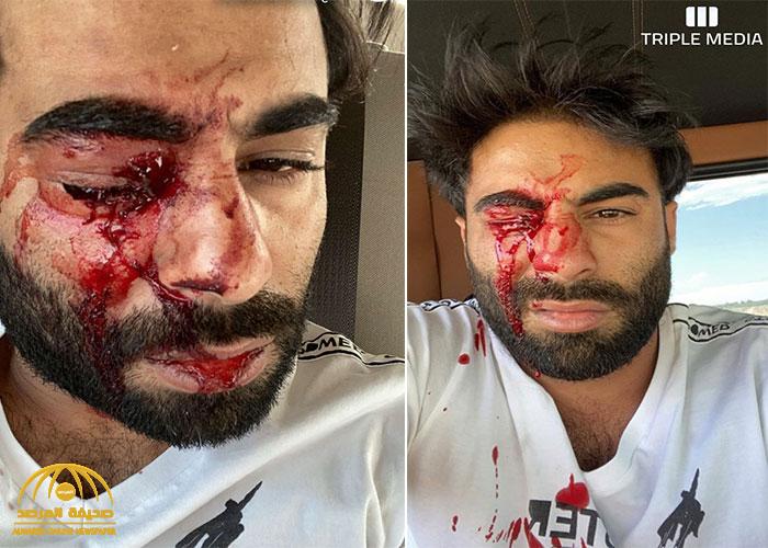 "عيني راحت " .. مشهور سناب "عبودكا" يكشف حقيقة الاعتداء عليه بآلة حادة !
