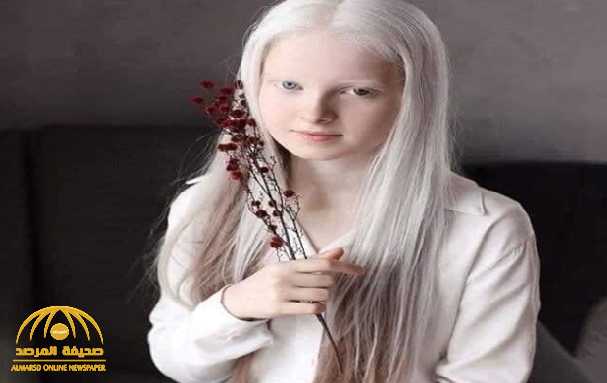 لُقِبت بـ"الملاك الأبيض" .. شاهد: فتاة حسناء تعاني من حالتين جينيتين نادرتين