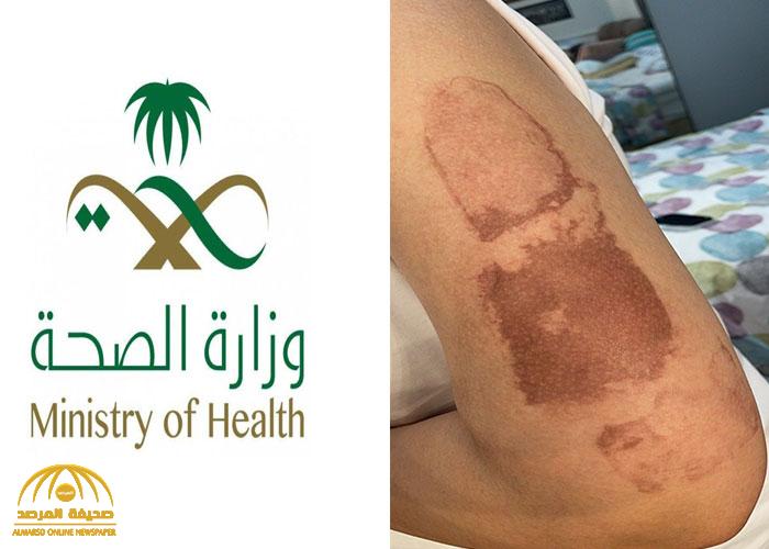 شاهد: ظهور بقعة غريبة على ذراع مواطنة بعد تلقيها لقاح كورونا.. والصحة تعلق : لا بأس عليك  بنصعد حالتك ونهتم بها