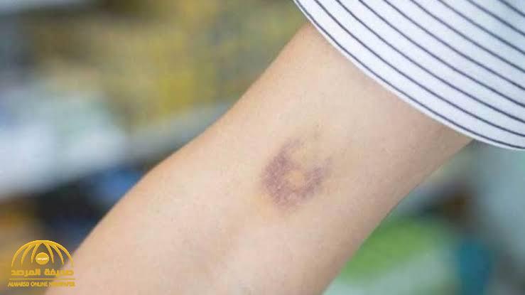 ظهور "البقع الزرقاء" على الجسم مؤشر على الإصابة بأمراض خطيرة