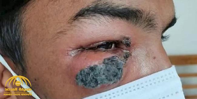 5 أشياء في منزلك تنقل لك الفطر الأسود