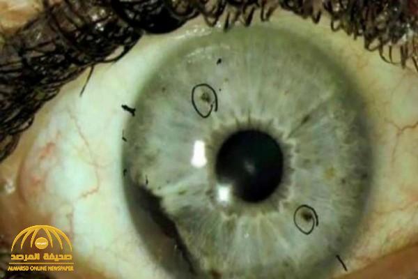 ما هو مرض "الفطر الأسود" وعلاقته بفيروس كورونا؟.. وكيف نتجنب الإصابة به؟