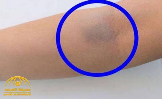 توجه للطبيب فوراً.. ظهور “البقع الزرقاء” على الجسم مؤشر على الإصابة بأمراض خطيرة