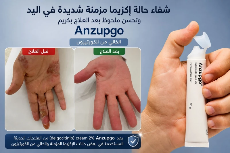 استشاري جلدية إماراتي يعلن شفاء حالة إكزيما شديدة باستخدام كريم" أنزبوجو" خال من الكورتيزون