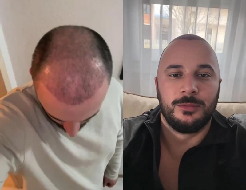 بالفيديو.. شاب تركي يوثق تجربته في زراعة شعر رأسه وتغير مظهره خلال 20 أسبوعًا